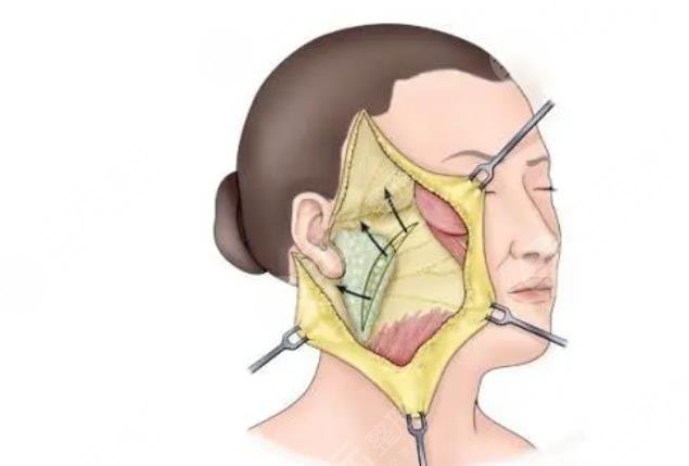 雙燕尾拉皮手術(shù)多少錢