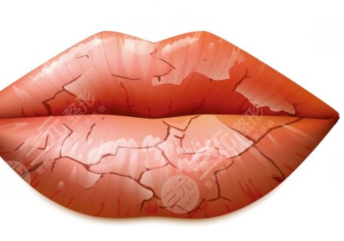 唇部老化的原因有哪些？唇部老化如何改良？