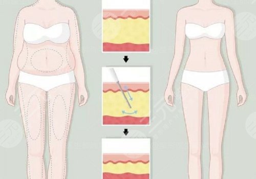 身體塑形能達(dá)到減肥的效果嗎？