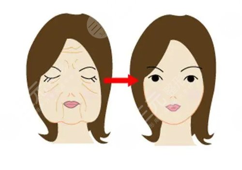 韌帶提升和拉皮的區(qū)別是什么？