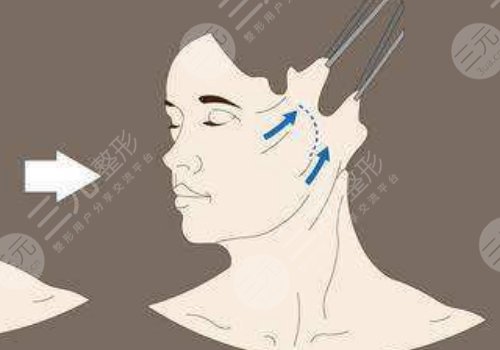 韌帶提升和拉皮的區(qū)別是什么？