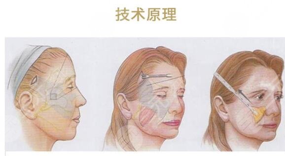 李青峰醫(yī)生拉皮除皺案例