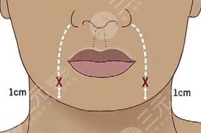 唇部整形