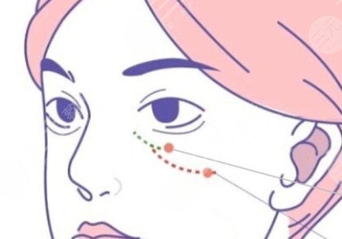 雙美膠原蛋白填充淚溝能維持多久？