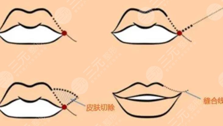 下唇厚外翻整形手術(shù)怎么做？科普及費用價格參考！