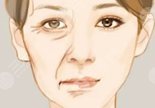 括號紋怎么去掉？怎么形成的？改良方式解讀！