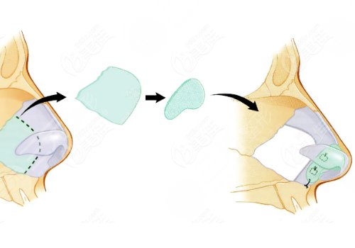 廣州市荔灣區(qū)人民醫(yī)院整形美容隆鼻怎么樣？