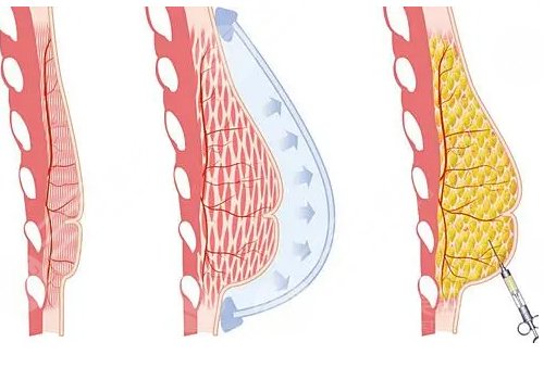深圳胸部整形醫(yī)生排名