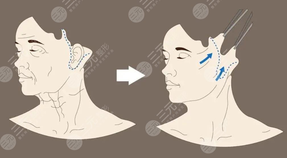 巴立超醫(yī)生拉皮手術(shù)案例