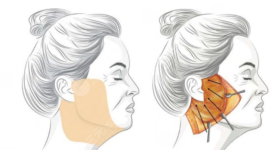 巴立超醫(yī)生拉皮手術(shù)案例