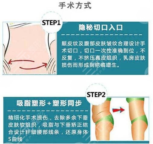 腰腹抽脂腹壁整形恢復(fù)期要多久？重塑小蠻腰，這些事你要知道！