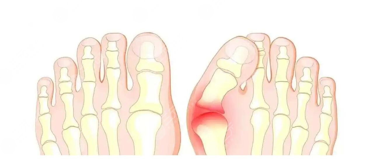 大腳骨怎么緩解比較好?