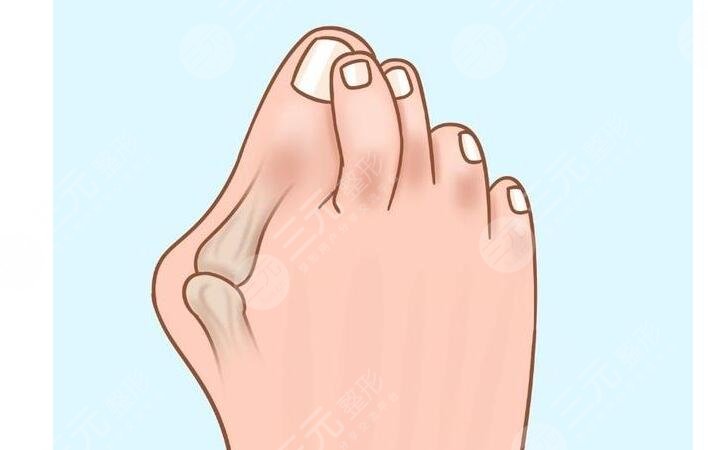 大腳骨怎么緩解比較好?