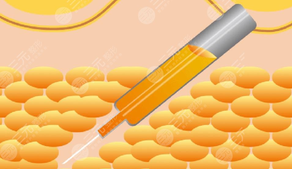 覃永喜醫(yī)生吸脂案例