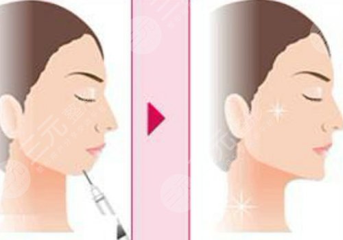 玻尿酸填充下巴有什么副作用？