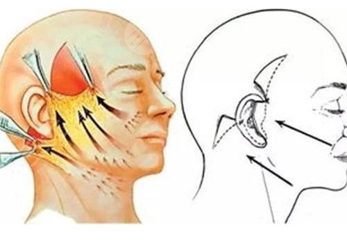 筋膜懸吊術(shù)適合多大年齡的？