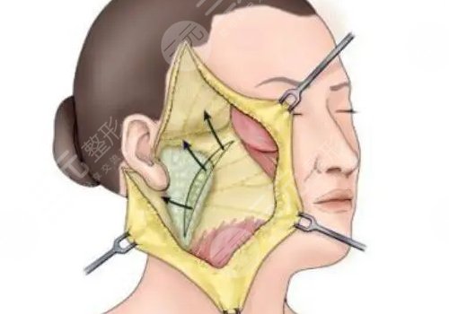 筋膜懸吊術(shù)適合多大年齡的？