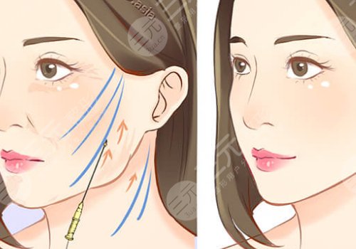 筋膜懸吊術(shù)適合多大年齡的？