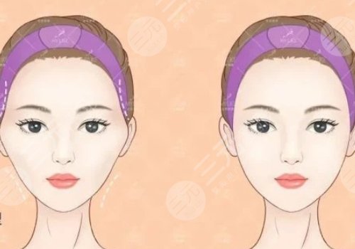 膠原蛋白填充太陽凹大概多少錢？