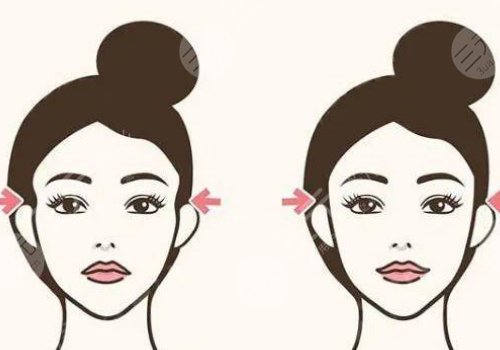 膠原蛋白填充太陽凹大概多少錢？