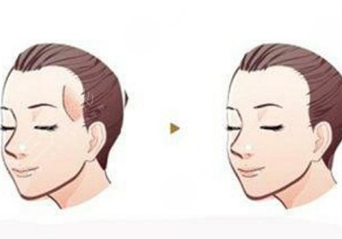 膠原蛋白填充太陽凹大概多少錢？