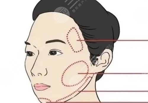 輪廓固定提升多少錢做一次好？