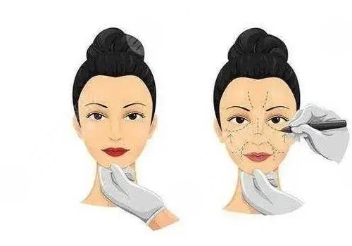 輪廓固定提升多少錢做一次好？