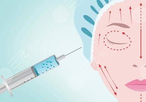 玻尿酸輪廓固定提升能保持多久呢？