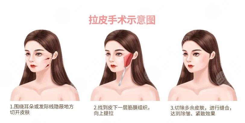 覃永喜醫(yī)生拉皮案例