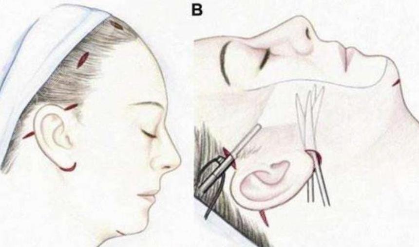 筋膜提升術(shù)