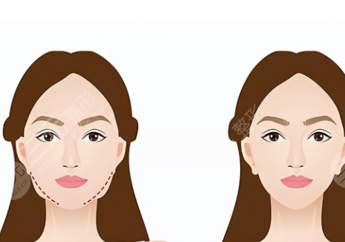 下頜提升針幾天有效果？