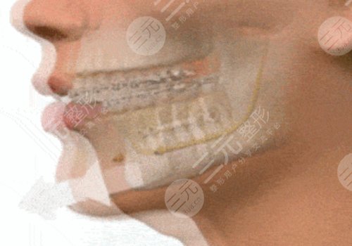 臉部骨骼變形能矯正嗎？