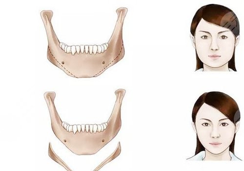 臉部骨骼變形能矯正嗎？