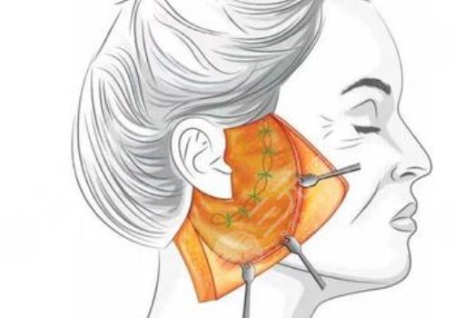 什么是筋膜懸吊面部提升術(shù)？