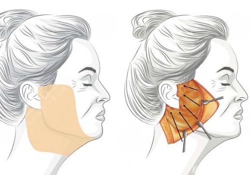 什么是筋膜懸吊面部提升術(shù)？