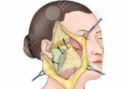 什么是筋膜懸吊面部提升術(shù)？