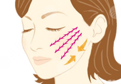 筋膜懸吊提升術(shù)能保持多久