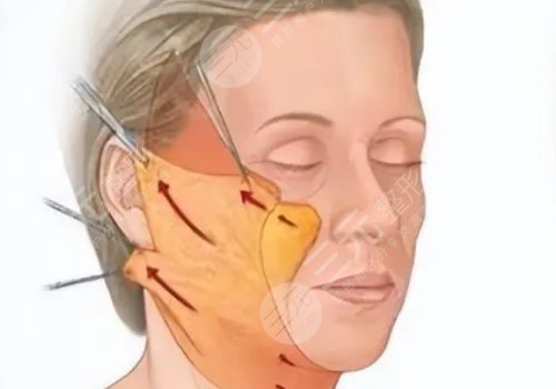 筋膜懸吊面部提升和線雕哪個好？