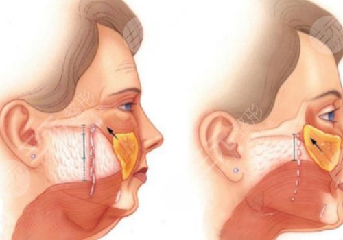 筋膜懸吊面部提升和線雕哪個好？