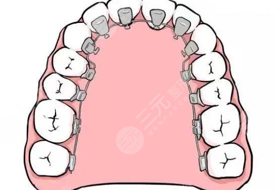 舌側(cè)隱形矯正
