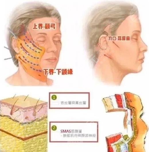 北京祝東升拉皮案例