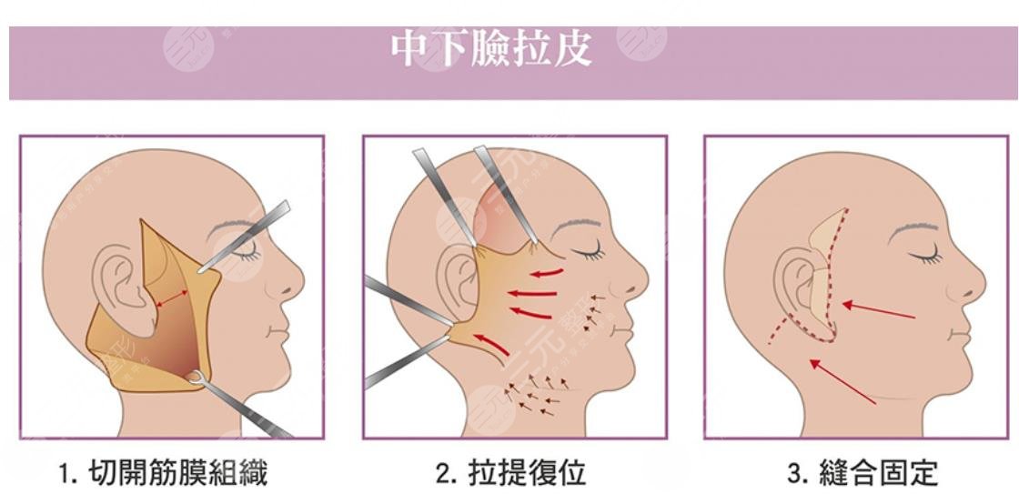 雙燕尾拉皮手術(shù)