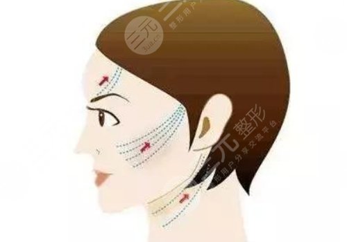 皺紋去除的好辦法是什么？