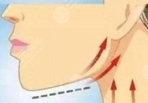 面部外輪廓固定怎么做？