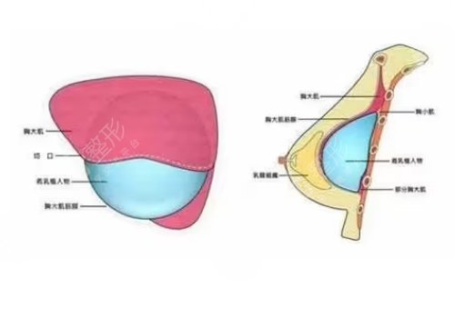 南京市第二醫(yī)院整形外科隆胸專家