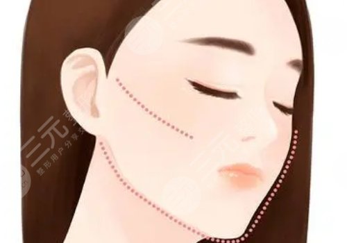 做完輪廓手術(shù)臉更大了怎么回事？