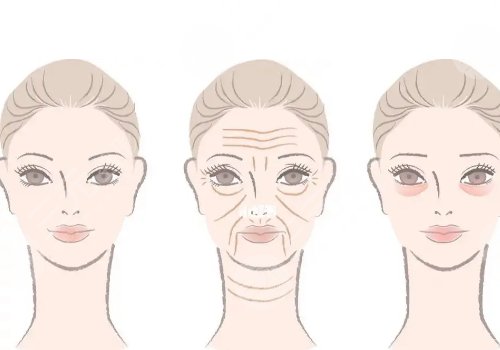 50歲做面部提升多少錢？