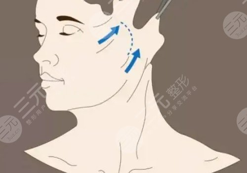 50歲做面部提升多少錢？