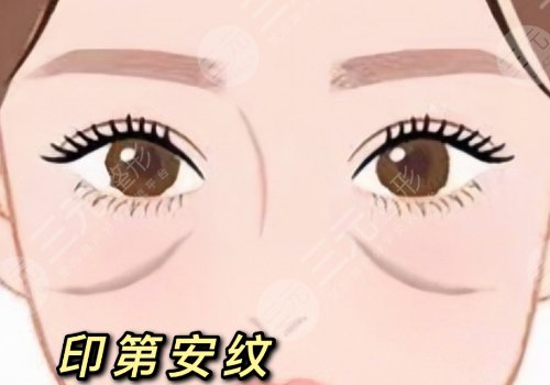 印第安紋是怎么形成的還能消除嗎