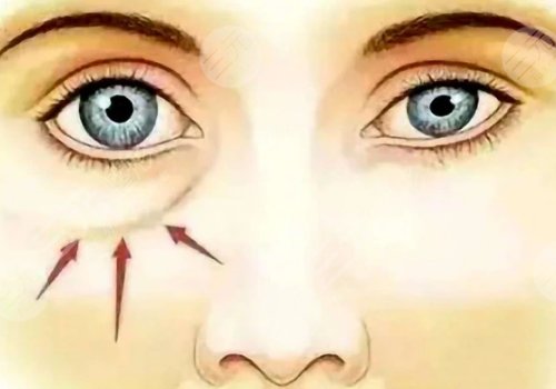 印第安紋是怎么形成的還能消除嗎